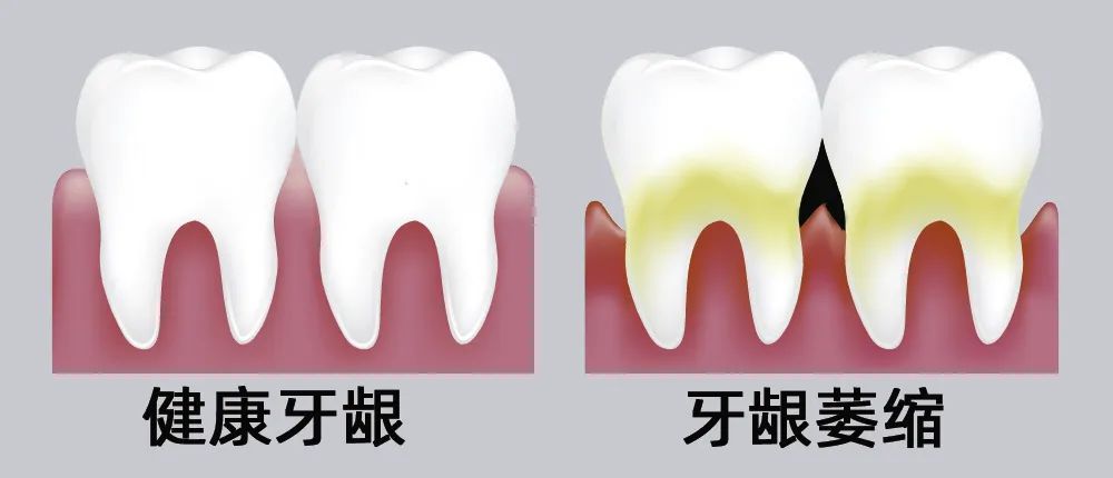 牙縫大露出“黑三角”，既塞牙又難看！還能恢復嗎？