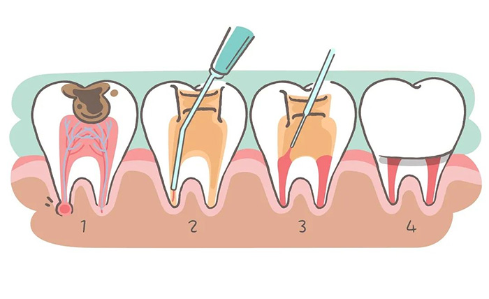 細(xì)說根管治療，聽聽專家怎么講...